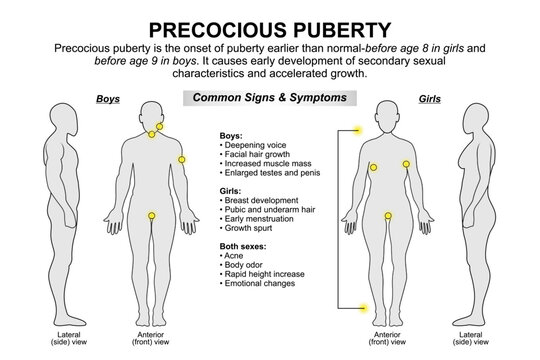 Precocious Puberty Medical Flashcard Illustration
