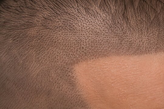 Extreme macro detail of scalp micropigmentation on a bald head