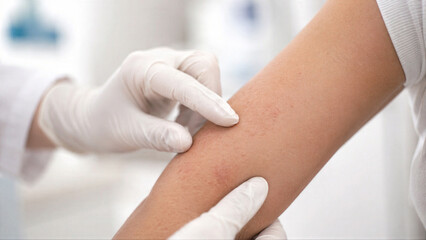 Fototapeta premium Doctor examining woman arm with skin irritation or insect bite. Medical professional checking patient symptom of infection, virus, or fever. Dermatological consultation in clinic office.