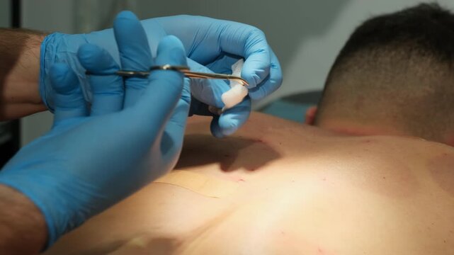 Surgeon hands use sterile forceps to remove patient blemish in hospital slow motion. Doctor gives wart treatment to man in dermatology clinic closeup