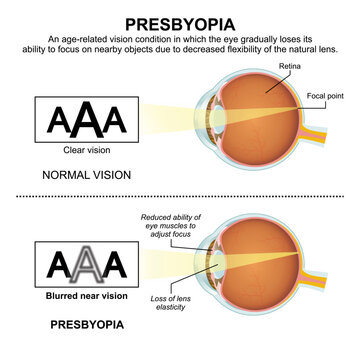 Presbyopia, Eye Vision Flashcard Illustration