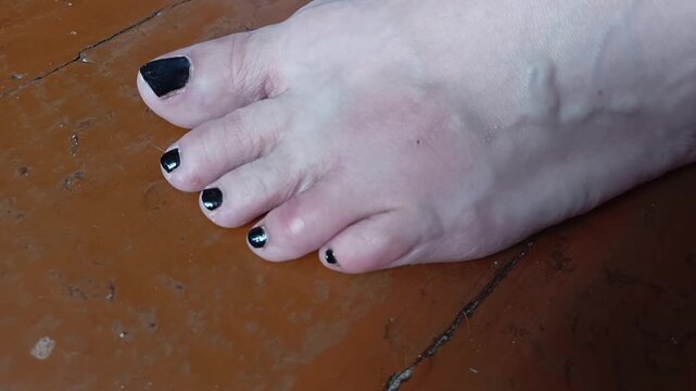 Contusion of the toe and foot of the first - second degree. Bruise on toe, foot