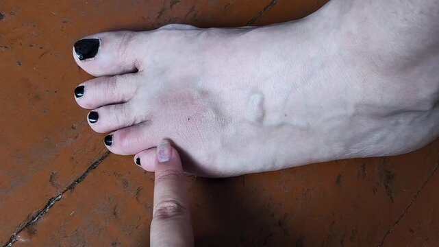 A woman touches a bruise on her toe. bruise on the foot after a blow