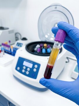 Centrifuged blood tube showing plasma separation for PRP, PRF, PPP and CGF preparation, representing regenerative medicine, autologous therapies, laboratory processing. Vertical photo
