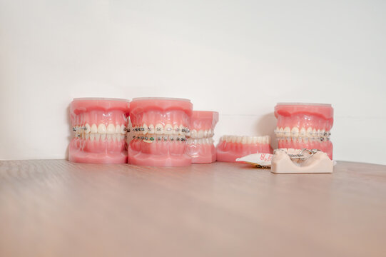 Collection of dental jaw models showing different types of orthodontic braces including metal ceramic and clear aligners on shelf. Educational display with bracket samples and appliance demonstrati...