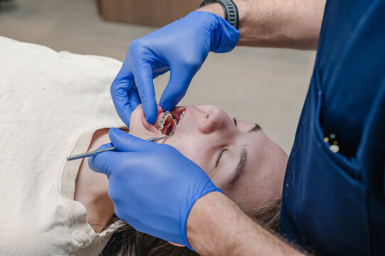 Close-up of orthodontist adjusting metal braces on upper teeth of teenage patient with blue gloved hands carefully positioning around mouth. Intimate procedure detail with visible brackets and arch...