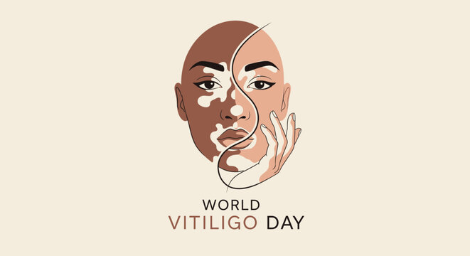 Vitiligo Awareness: Woman's Face with Skin Pigmentation Disorder and World Vitiligo Day Text