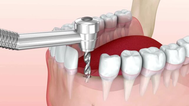 Close-up of dental drill performing a tooth preparation procedure on a patient's upper teeth