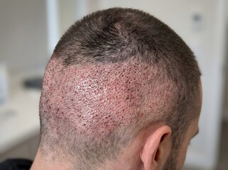 Fototapeta premium Hair Transplant in Crown Area Showing Early Recovery Stage