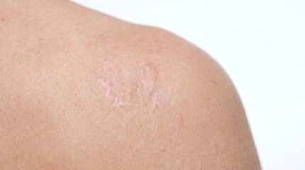 Fototapeta premium Close-up of a person's shoulder with distinct light-colored keloid scars on skin