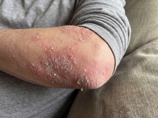 Fototapeta premium A professional photography close-up shot of a person's elbow showing clear signs of Psoriasis, featuring well-defined erythematous plaques covered with silvery, dry scales that are partially flaking o