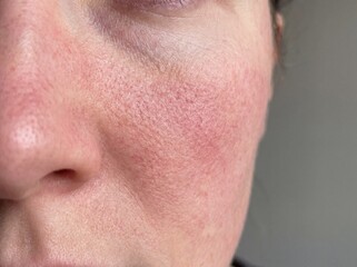 Naklejka premium A professional photography close-up shot of a person's cheeks and the bridge of the nose exhibiting Rosacea, characterized by persistent facial redness, flushing, and small, visible superficial blood