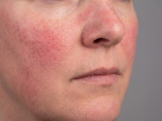 Obraz premium A professional photography close-up shot of a person's cheeks and the bridge of the nose exhibiting Rosacea, characterized by persistent facial redness, flushing, and small, visible superficial blood