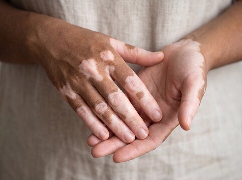 A professional photography close-up shot of a person's hands and fingers displaying Vitiligo, showing a stark, clear contrast between the natural skin tone and smooth, depigmented white patches of ski