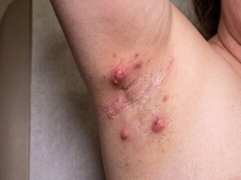 A professional photography shot of a person's armpit area showing Hidradenitis Suppurativa, with deep, painful, inflamed nodules and scarring in the sweat gland regions, realistic medical presentation