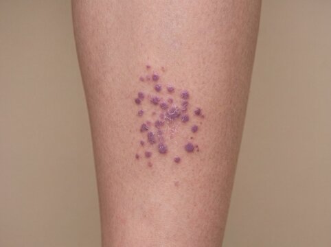 A professional photography shot of a person's shin exhibiting Lichen Planus, showing a cluster of shiny, flat-topped, purplish papules with fine white lines on the surface, professional photography, n