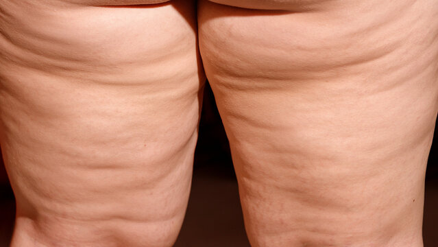 Back of woman's thighs showing natural cellulite skin texture close-up body positivity