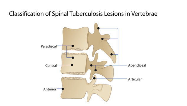 Classification of Spinal Tuberculosis Lesions in Vertebrae 
Educational anatomy diagram demonstrating the classification of spinal tuberculosis lesions and their characteristic distribution.