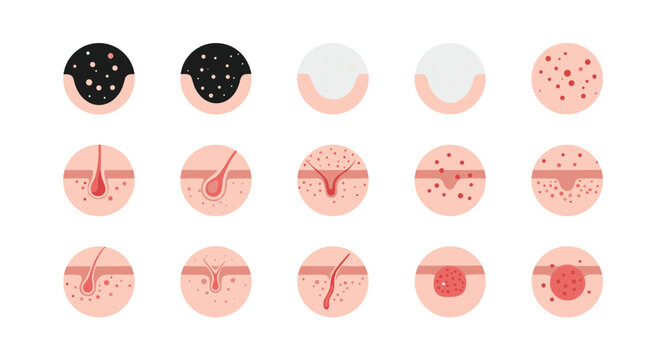 Various types of skin conditions and acne diagrams showing blackheads, whiteheads, and pimples for dermatology education.