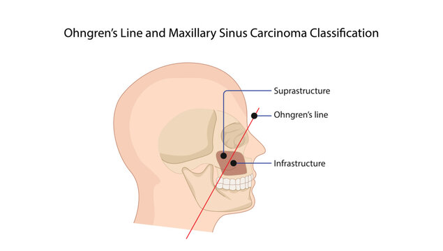 Ohngren&rsquo;s Line and Maxillary Sinus Carcinoma Classification demonstrating Ohngren&rsquo;s line dividing the maxillary sinus into suprastructure and infrastructure regions for tumor localization 