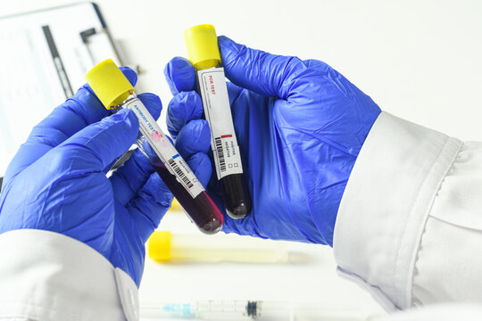 Blood sample tubes for Ebola PCR and antibody testing