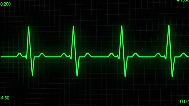 A green electrocardiogram reading on a black background with a grid pattern showing a normal heart rhythm with several peaks.