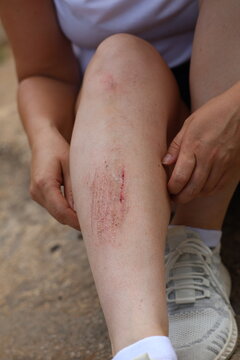 A fresh, bleeding abrasion or laceration on a person's skin following a fall. A close-up of an abrasion (scrape) with visible blood on a person's leg (shin). A concept illustrating first aid, househol