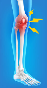 3D vector Human kneecap model arthro phlogosis joint swelling joint pain