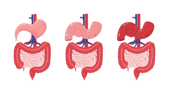 Medical illustration of human digestive system, stomach anatomy showing normal, indigestion, and acid reflux conditions.