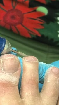Close up medical pedicure toenail treatment procedure performed by specialist, professional foot care and hygiene concept.