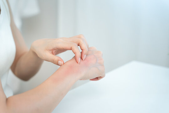 skin problem and beauty. Young woman scratch body has itchy skin from skin allergic, steroid allergy, sensitive skin, red from sunburn, chemical allergy, rash, insect bites, Seborrheic Dermatitis.