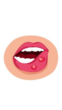 animation revealing appearance of recurring oral herpes episodes