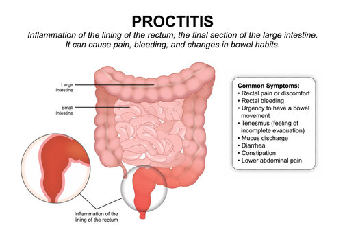 Proctitis, Rectum inflammation Flashcard Illustration