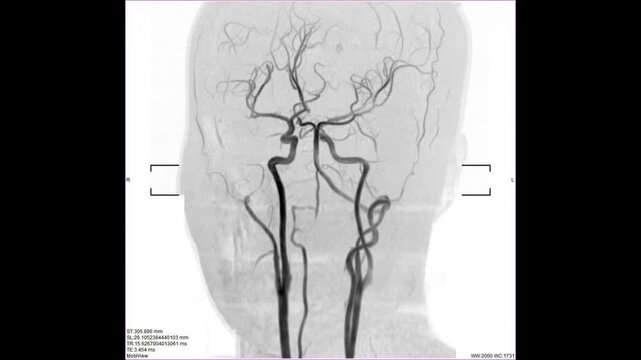 angiography by mri or mra blood vessels x-ray images to show brain stroke and aneurysm or ischemic.