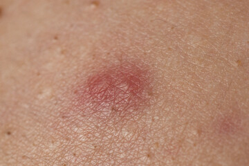 Fototapeta premium Skin rash texture with acne. Inflamed skin bumps acne macro. Macro shot of skin irritation with acne. Irritated acne skin.