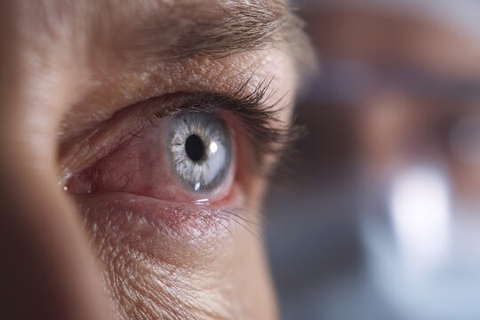 Eye health image: close-up of pale inner eyelid as a clinical sign of anemia in a healthcare setting