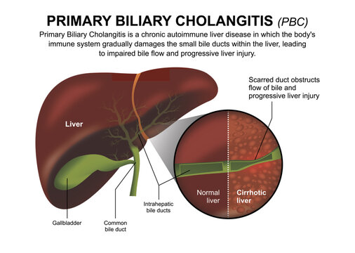 Primary Biliary Cholangitis (PBC) Liver Flashcard