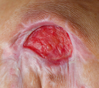 Close-up macro shot of a deep pressure ulcer (bed sore) on human skin, showing red granulation tissue and surrounding scar tissue.