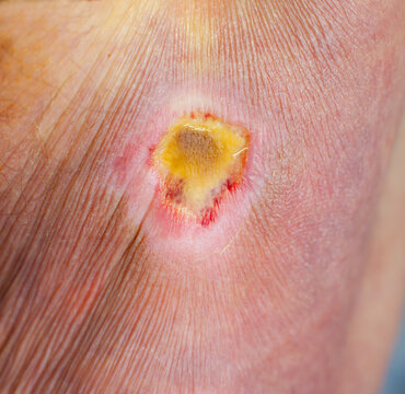 Macro photograph of a deep pressure ulcer (bed sore) on human skin showing red granulation tissue
