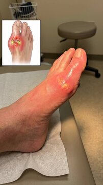 Inflammatory foot condition: painful joint, uric crystal, red skin, swollen toe, MTP articulation, body ailment, medical process, health issue, acute attack, gouty arthritis.