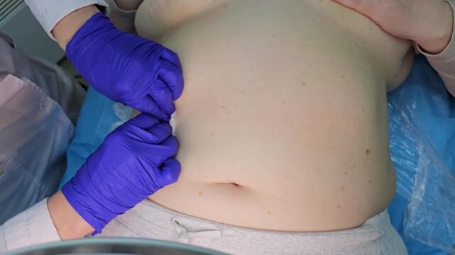 Professional removal of papillomas and moles with electrocoagulation procedure in dermatology clinic. overweight European woman on the surgical table. moles papillomas neoplasms on the body