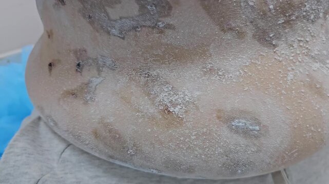 Professional removal of papillomas and moles with electrocoagulation procedure in dermatology clinic. overweight European woman on the surgical table. moles papillomas neoplasms on the body