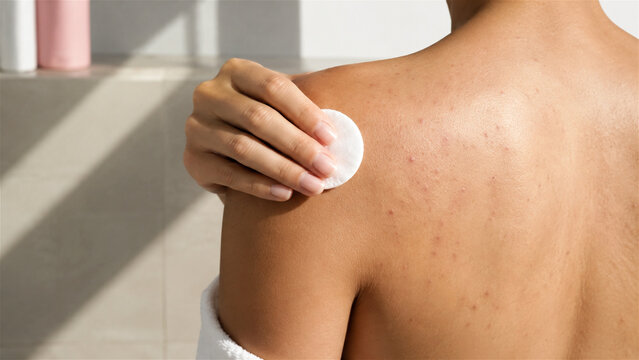woman applying toner on back skin with cotton pad to treat acne. Person performing daily body care routine for problematic skin. Healthcare, hygiene, dermatology and beauty treatment
