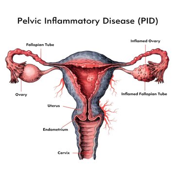 Medical illustration showing the female reproductive system affected by pelvic inflammatory disease with labels