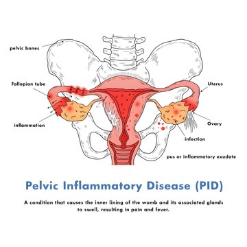 Diagram illustrating pelvic inflammatory disease with labeled anatomical structures and inflammation indicators