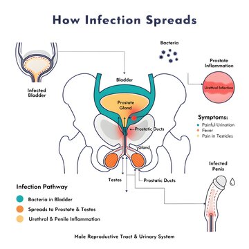 Visualizing the Male Reproductive and Urinary System Infection Pathway and Symptoms