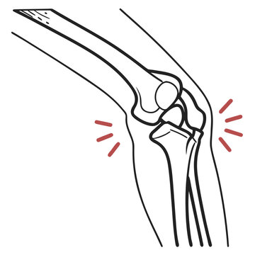 Vector illustration illustration of a human knee joint with pain indicators