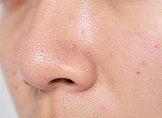 Fototapeta premium Extreme close up of human nose skin with blackheads and clogged pores