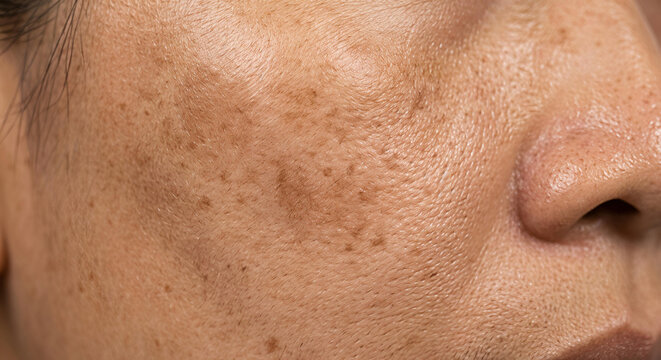 Close up of facial skin with dark spots, freckles, and hyperpigmentation