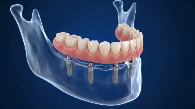 Detailed 3D medical animation of dental implants in transparent jawbone, titanium posts and prosthetic arch placement on blue background